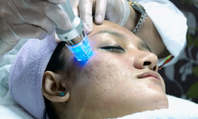 Beragam Cara Menghilangkan Flek Hitam dan Bekas Jerawat di Wajah