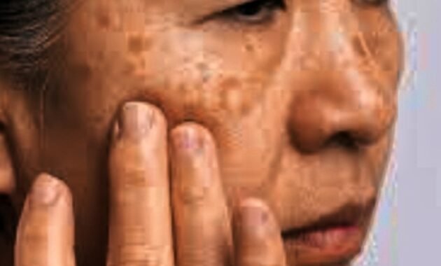 5 Cara Alami Menghilangkan Flek Hitam Membandel di Wajah, Mudah Sekali!