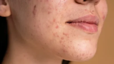 Cara Alami Hilangkan Jerawat: 6 Bahan Ampuh & Aman di Rumah